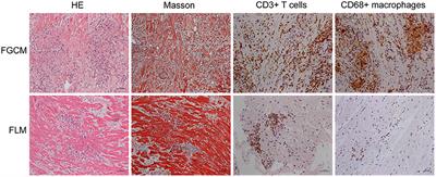 Fulminant Giant Cell Myocarditis vs. Lymphocytic Myocarditis: A Comparison of Their Clinical Characteristics, Treatments, and Outcomes